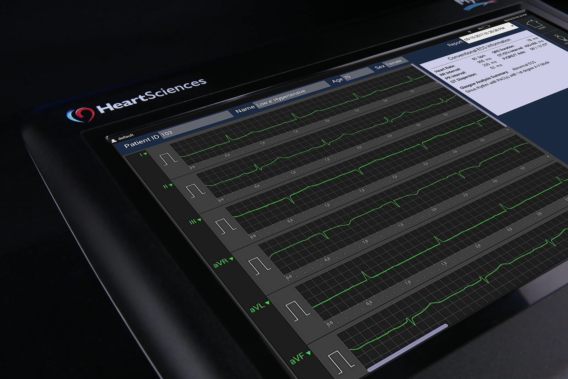 MyoVista wavECG™ device displaying ECG traces