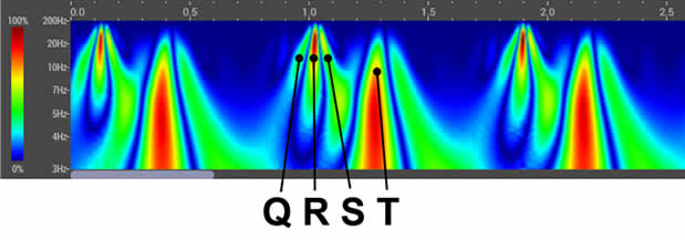 Waveform QRST Graphic